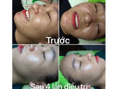 Spa Điều Trị Mụn Uy Tín Quận 12